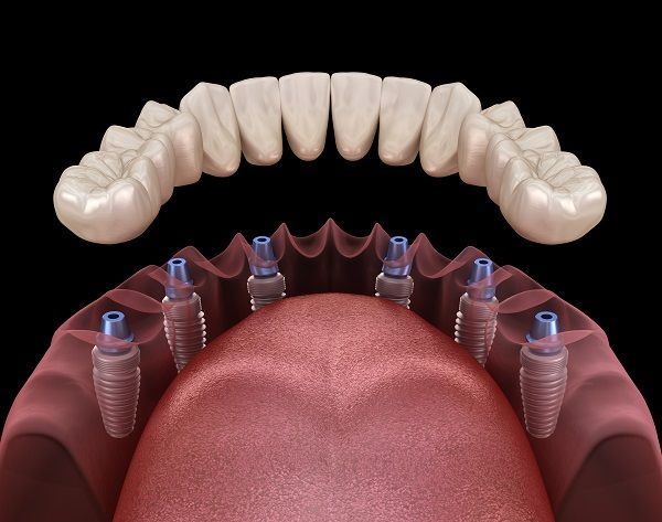 Prothèse amovible stabilisée sur implant